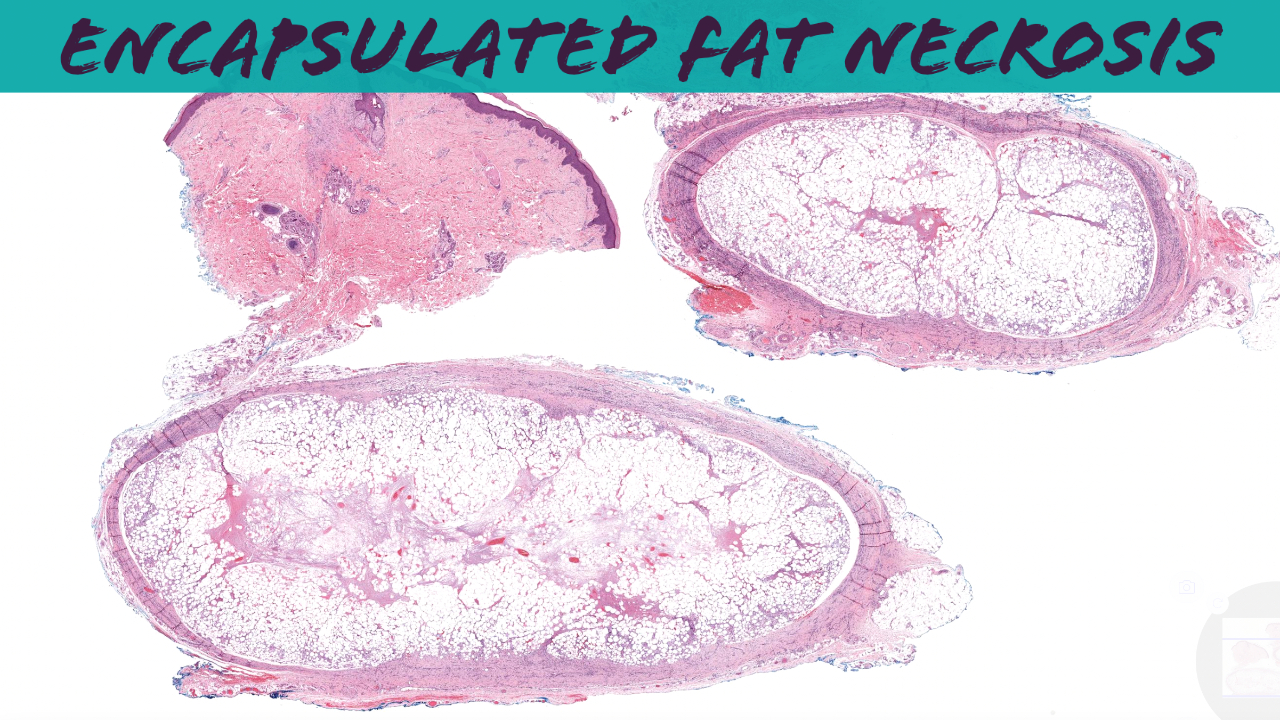 Posttraumatic fat necrosis (encapsulated subcutaneous fat necrosis